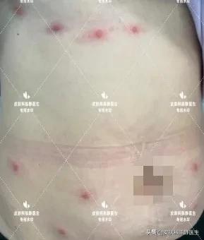 有人被咬,在床上被咬一身红疙瘩