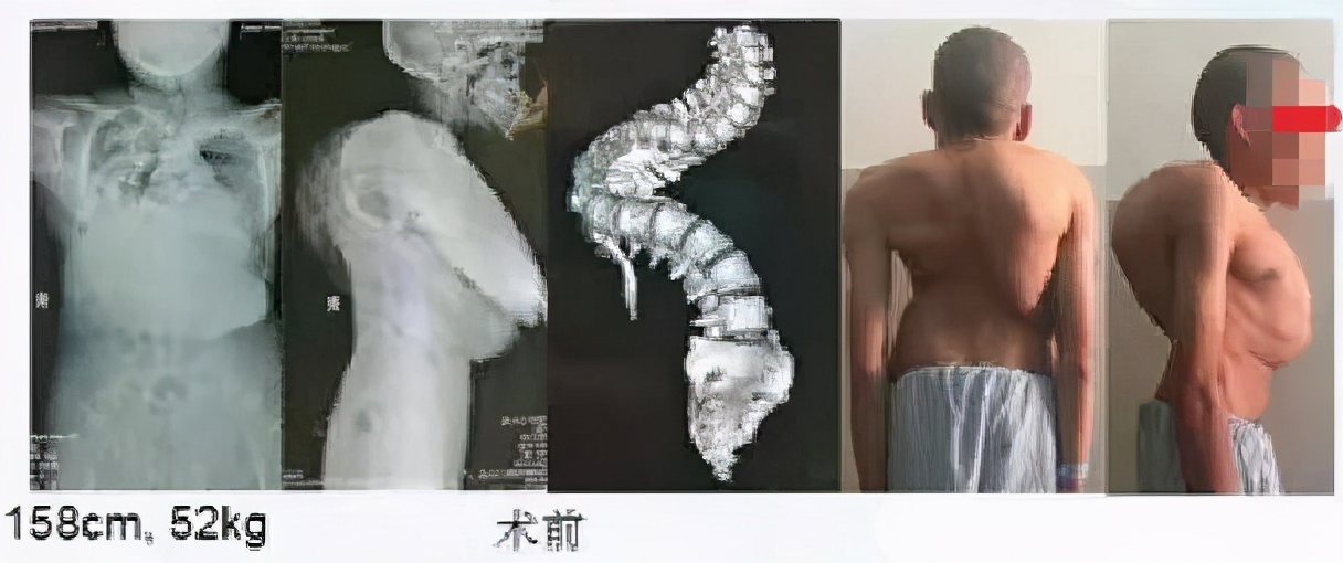 成人脊柱畸形矫形策略是什么,脊柱畸形医疗救治