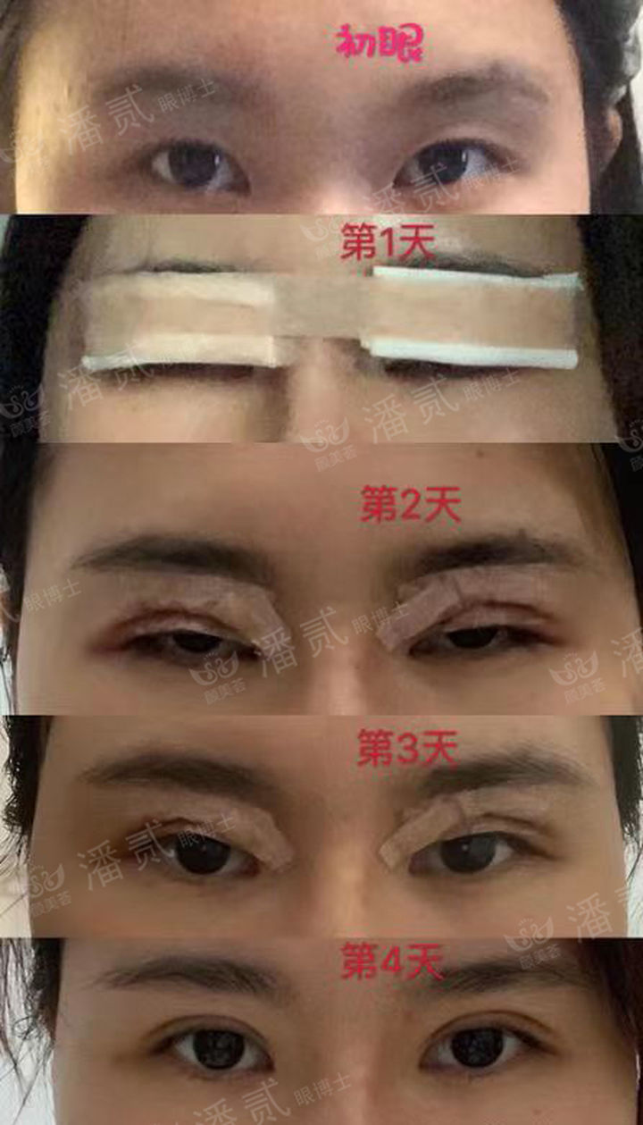 原来双眼皮不好看有必要继续割吗,割双眼皮是不是越修复越难看