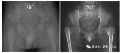 儿童髋外翻怎么治疗,儿童髋内翻是什么原因