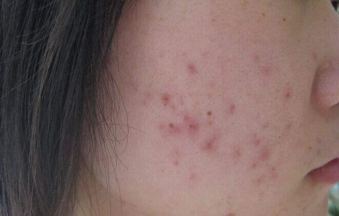 博乐达水杨酸祛闭口多久能有效,博乐达水杨酸面膜去闭口怎么样