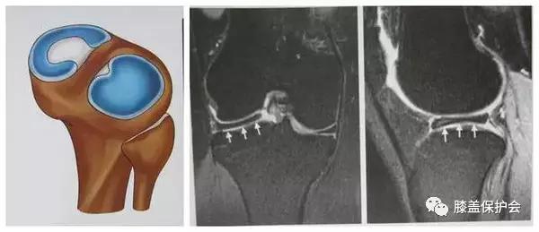 半月板受伤的理由,半月板最怕的动作别再做了