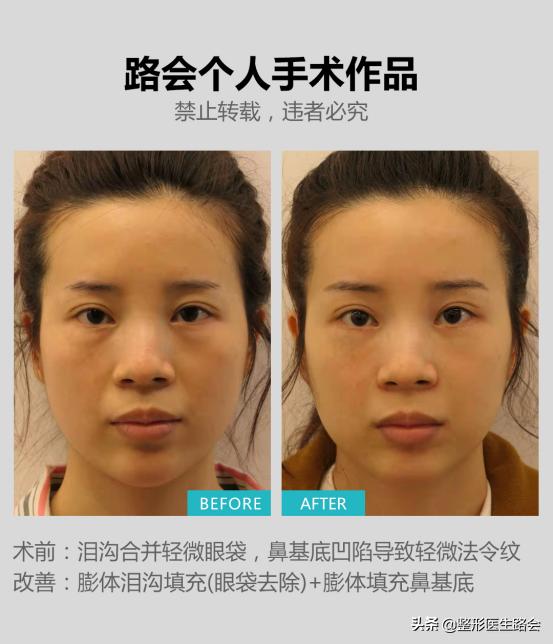 假体材料都有哪几种,假体材料都有什么