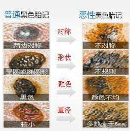 黑毛痣容易出现恶化病变吗