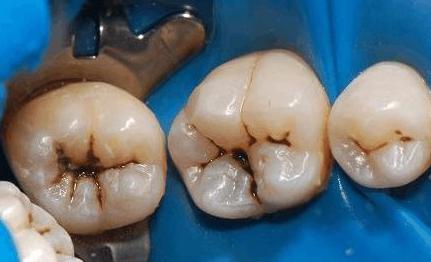 蛀牙不补还可以忍忍,补完牙反而更疼了!被坑坏了