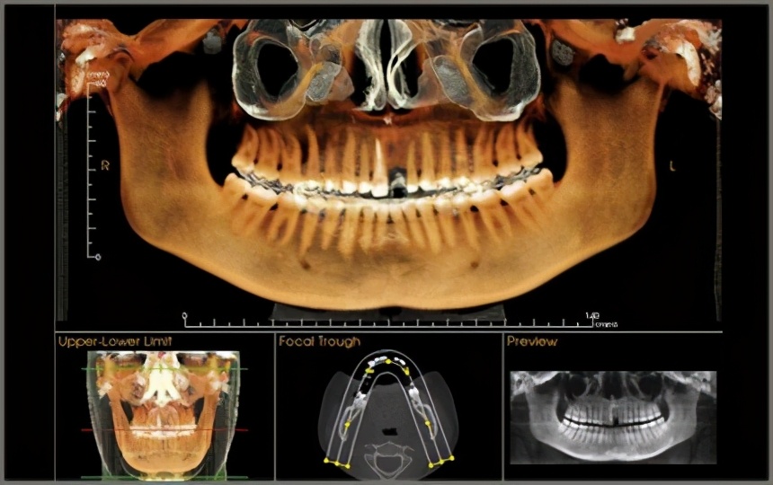 牙齿矫正需要注意哪些消费陷阱,矫正牙齿怎么避免隐形收费