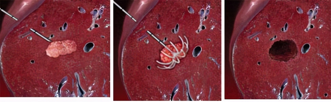 肝癌腹腔镜消融和ct消融哪个好,射频消融治疗肝癌的优缺点是什么