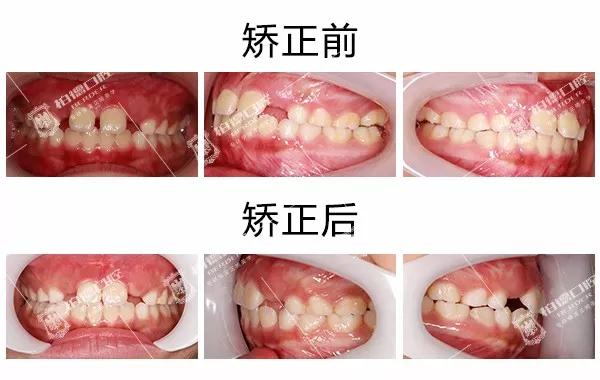 儿童牙齿早期干预矫正有几种,儿童牙齿早期矫正图片