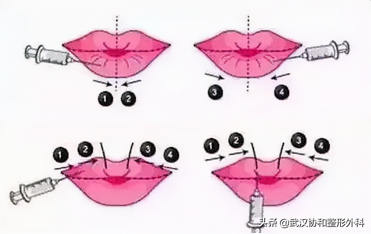 常见的唇部整形都有哪些,常见的唇部整形有哪些