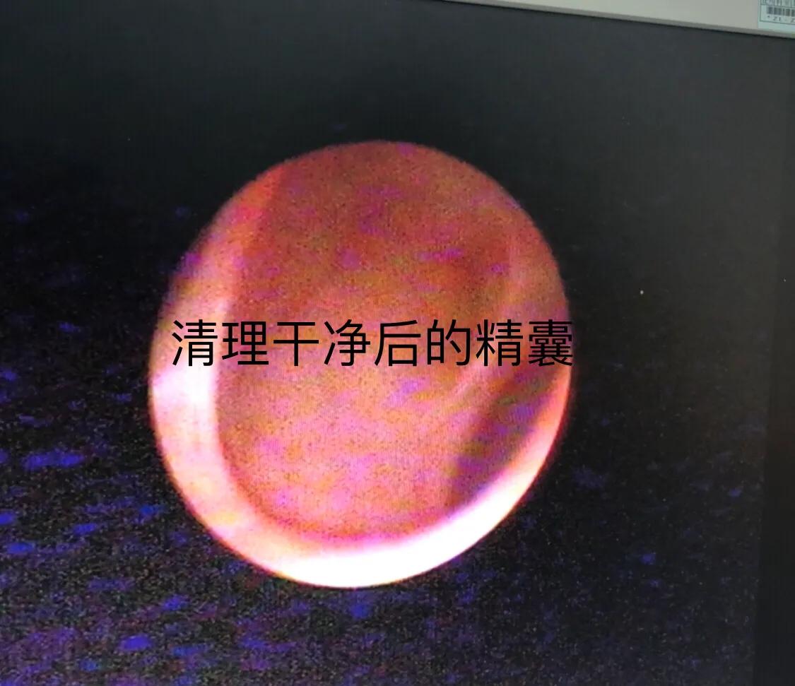 精囊结石精囊镜,精囊镜与钬激光手术