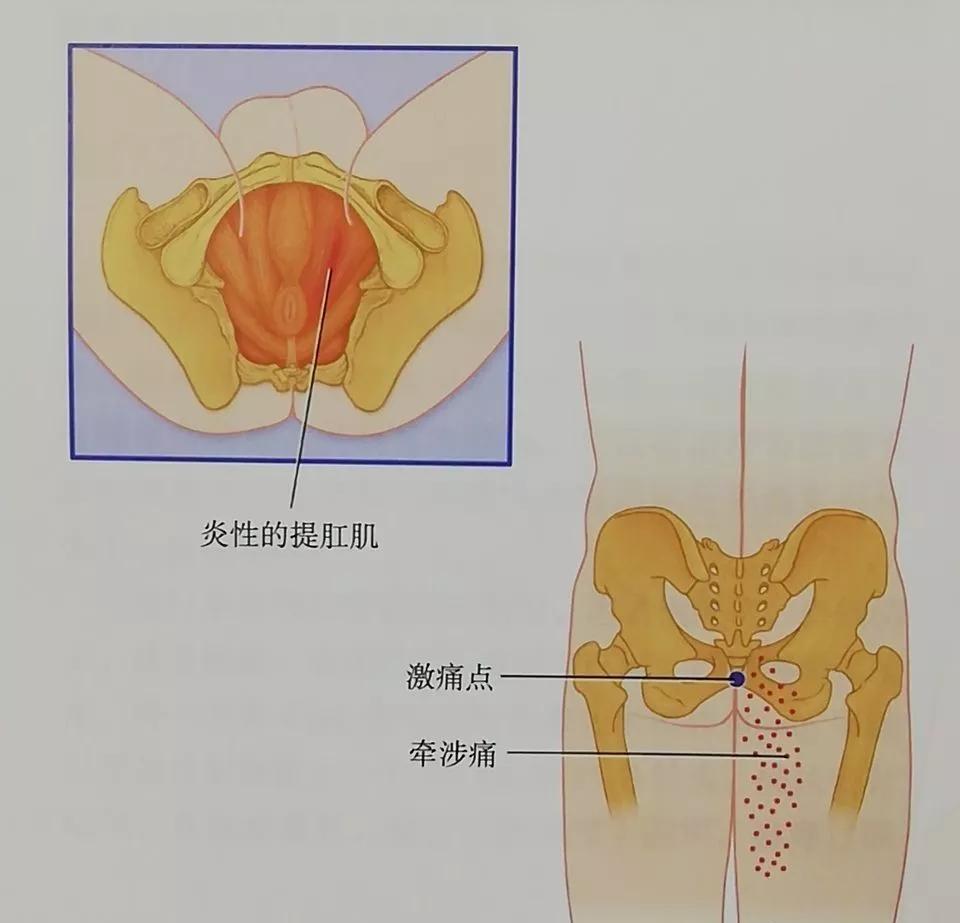 收藏综合征,男性骨盆疼痛综合征