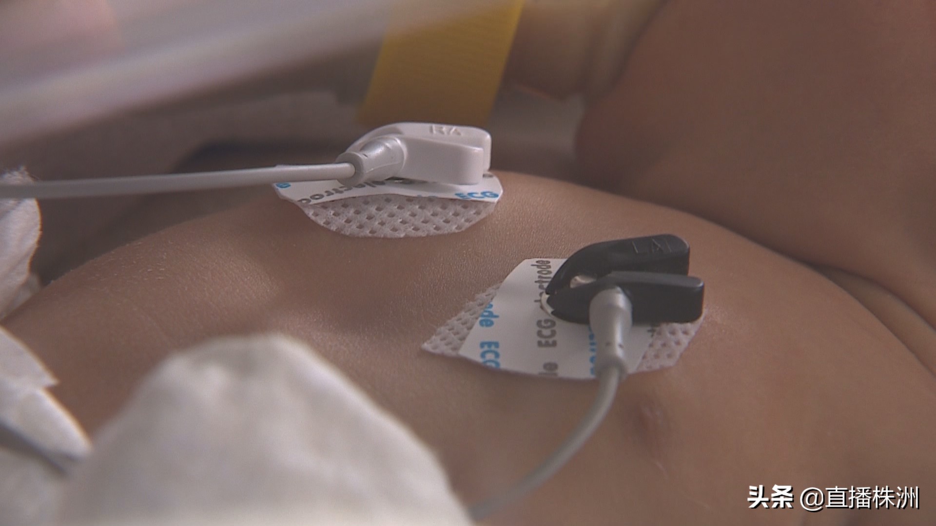 早产儿呼吸困难有危险吗,早产儿呼吸窘迫综合征要紧吗