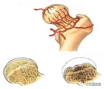 股骨头坏死漏诊图片,太康陈医生治疗股骨头坏死