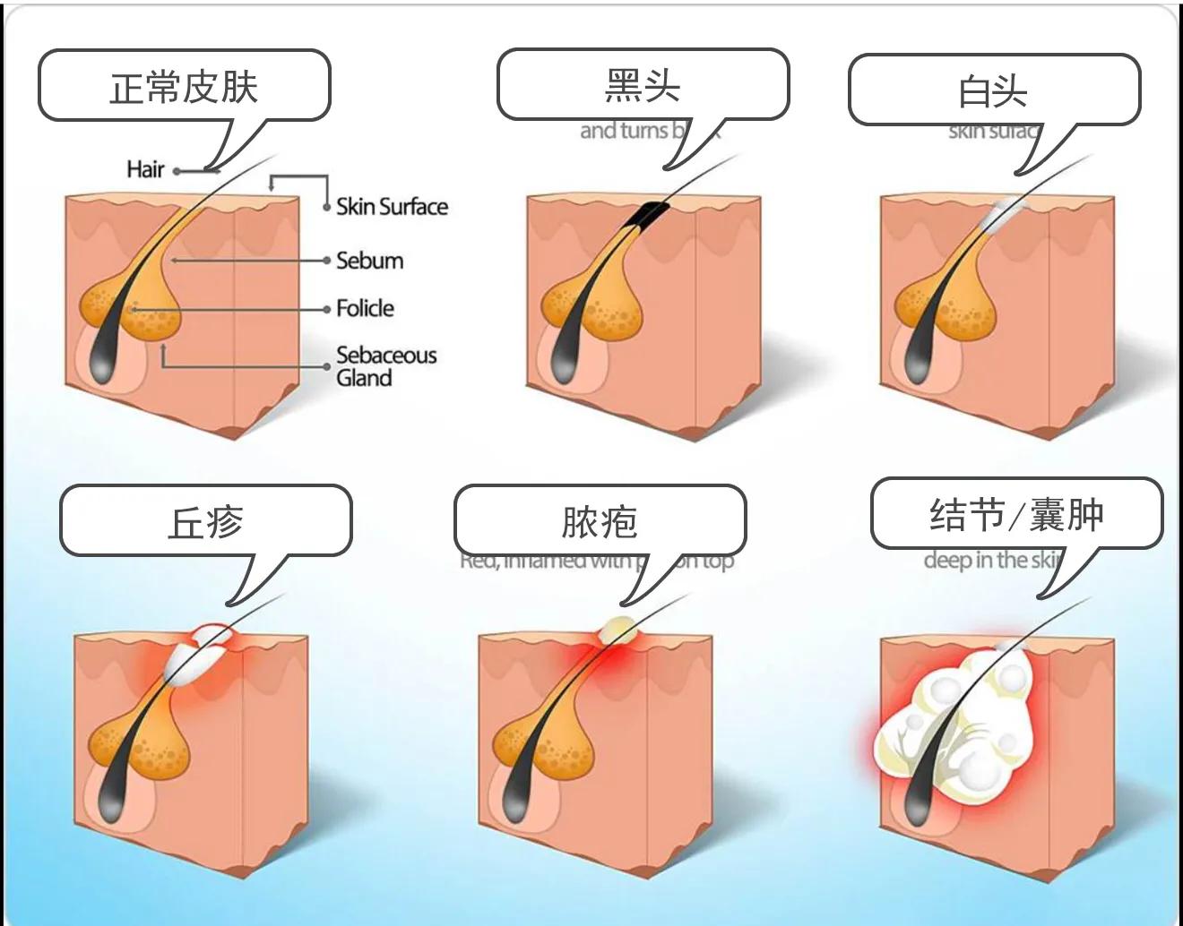 面部生疮后的瘢痕怎么办,疮疤去除