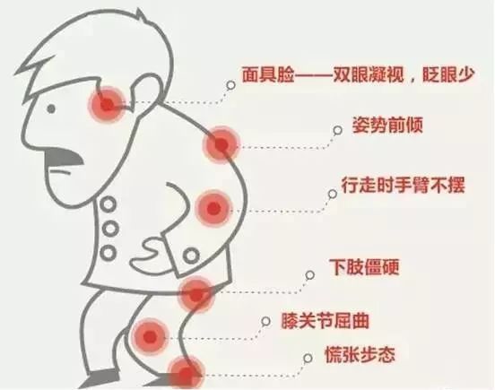 患上帕金森不要怕,科学治疗帕金森让你从此不怕