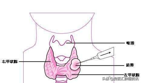 穿刺结束有点疼痛,穿刺抽血后筋痛