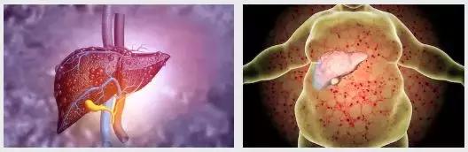 重度脂肪肝为啥医生说没啥问题,重度脂肪肝是不是严重了