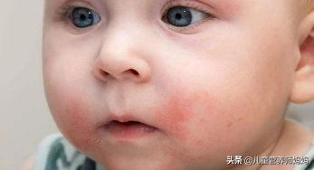 宝宝西红柿过敏会红屁股吗,孩子西红柿过敏怎么办