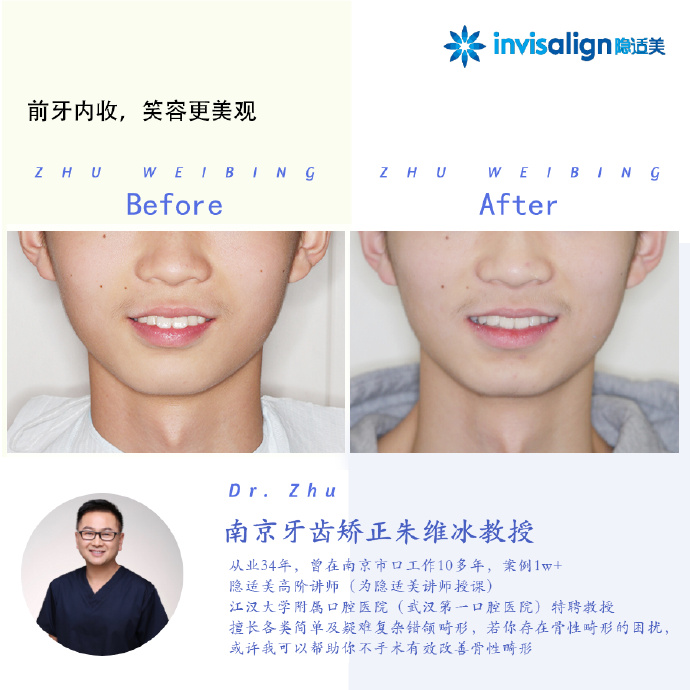 口腔正畸隐适美隐形矫治技术,隐适美深覆合矫正