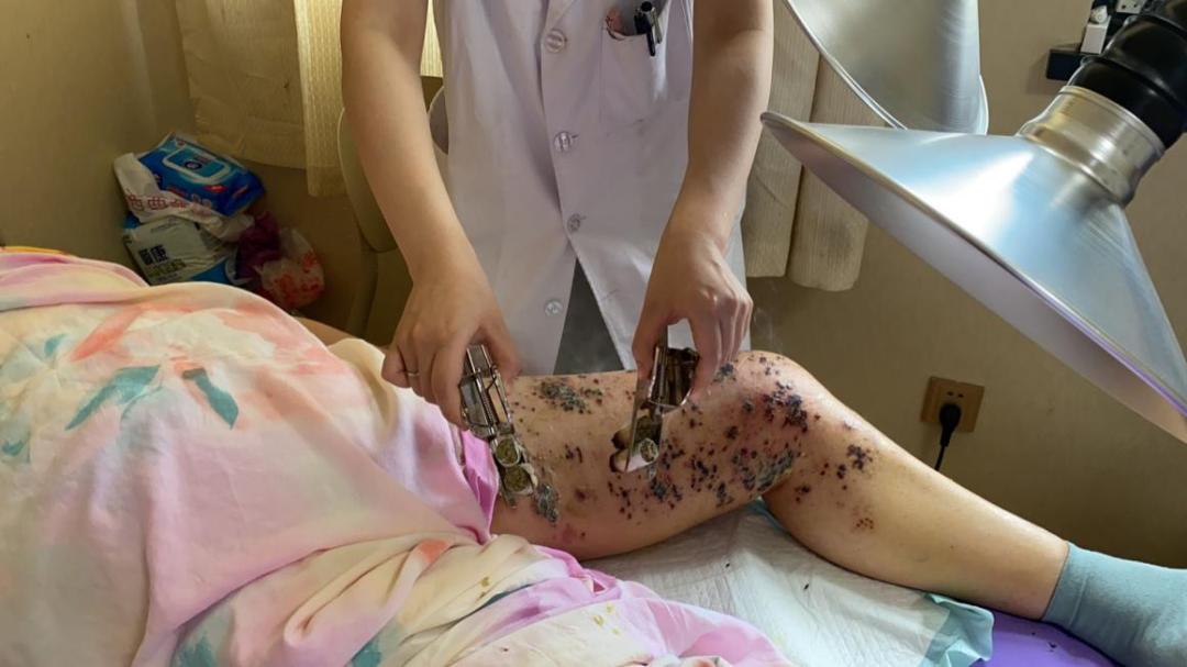 中药治带状疱疹痛有什么良方,中医治带状疱疹后肩膀疼