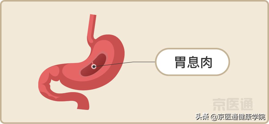 升结肠0.4息肉是癌的可能性是多少,胃体多发息肉0.2-0.4是癌吗