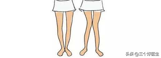 改善腿型的最佳方法,康复科医生教你怎么矫正腿型