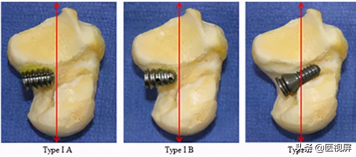 17岁平足症怎么治疗,青少年平足怎么办