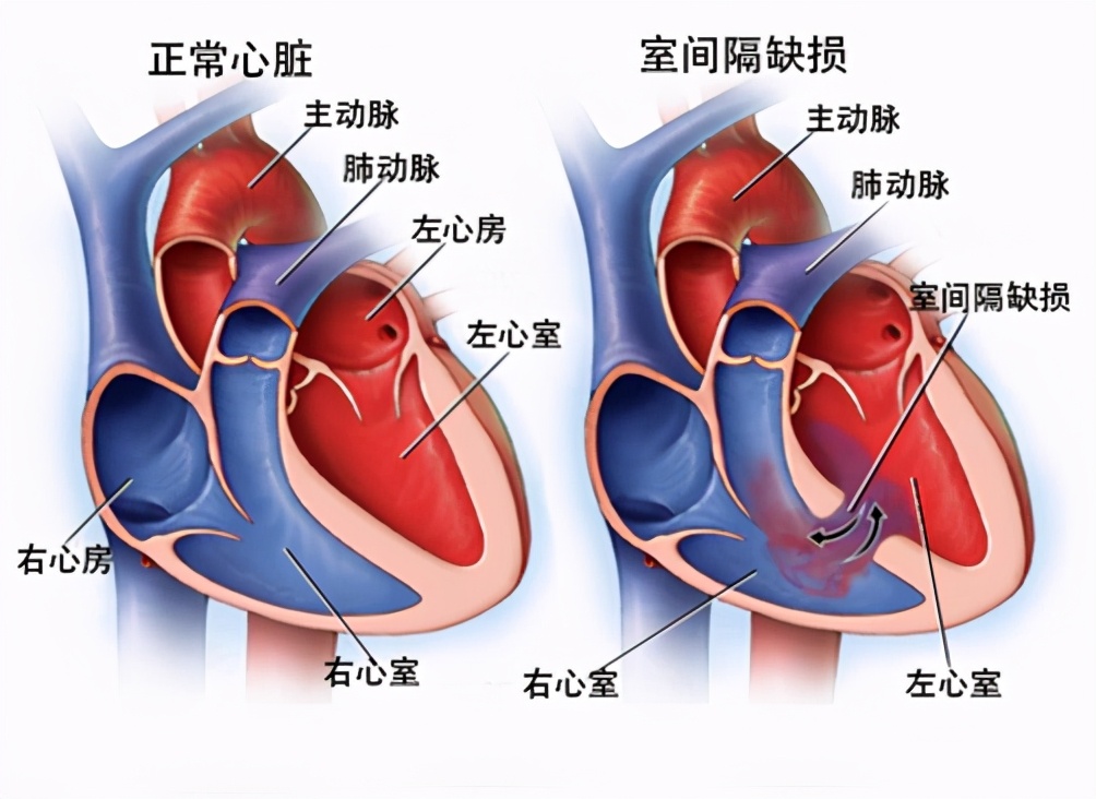 室间隔缺损3毫米自愈的几率,室间隔缺损膜周部