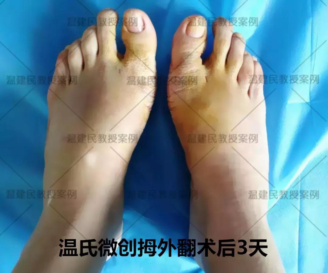 微创拇外翻手术有哪些后遗症,拇外翻微创手术效果好吗