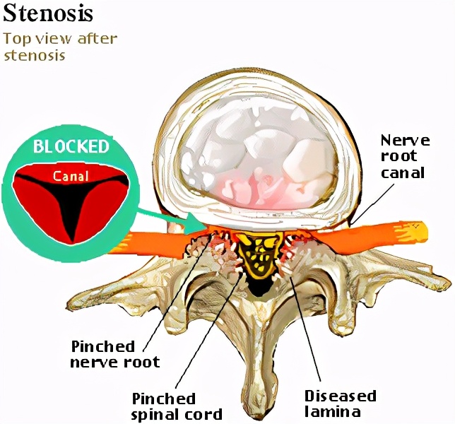 腰椎管狭窄一般能活多少年,腰椎管狭窄怎么锻炼最有效