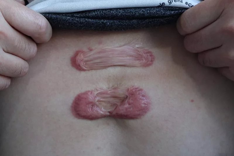 夏天疤痕治疗怎么做,多年疤痕秋冬疤痕痒怎么消除