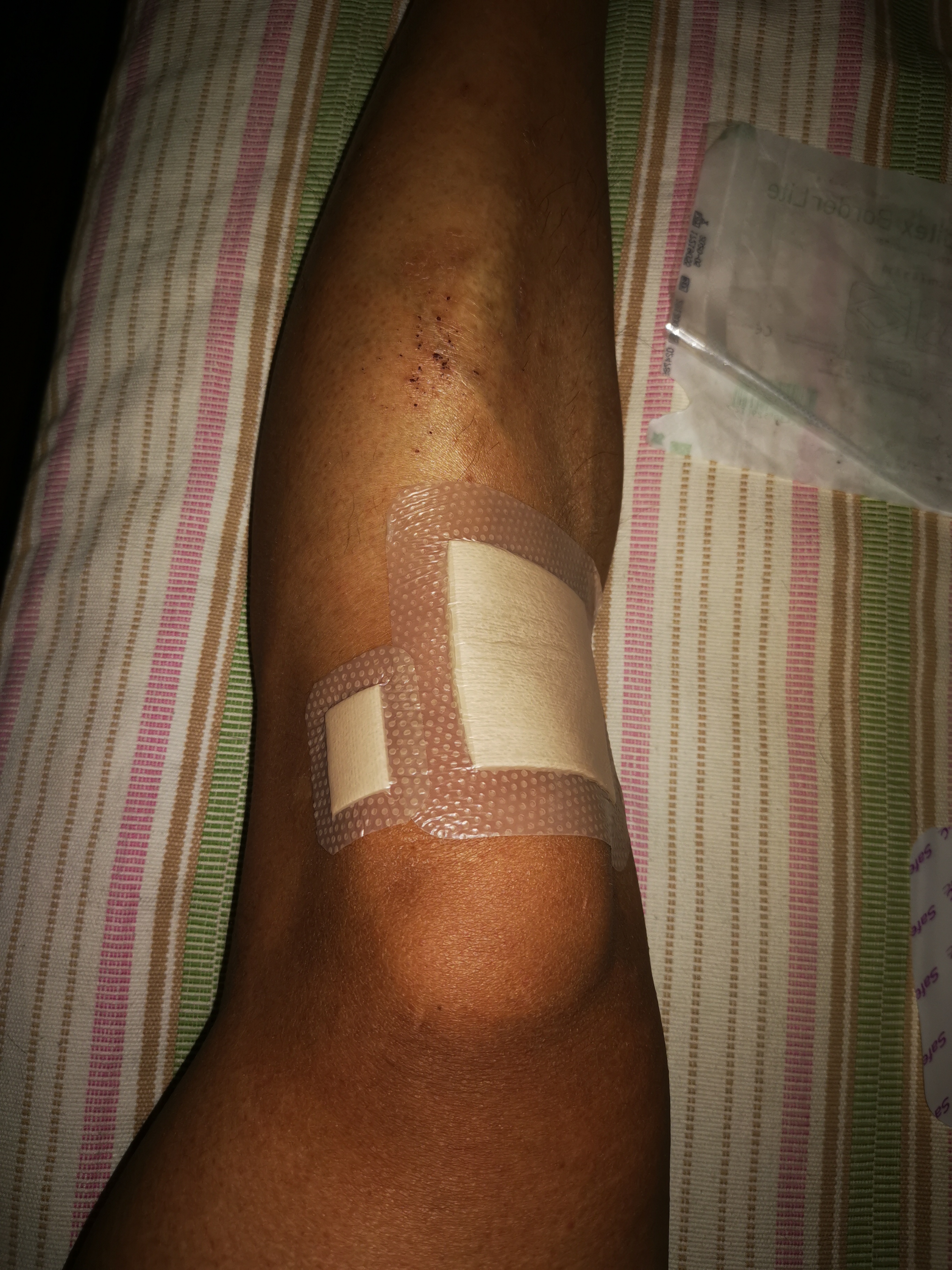 疤痕贴瑞典墨尼克术后多久用,瑞典墨尼克美皮护