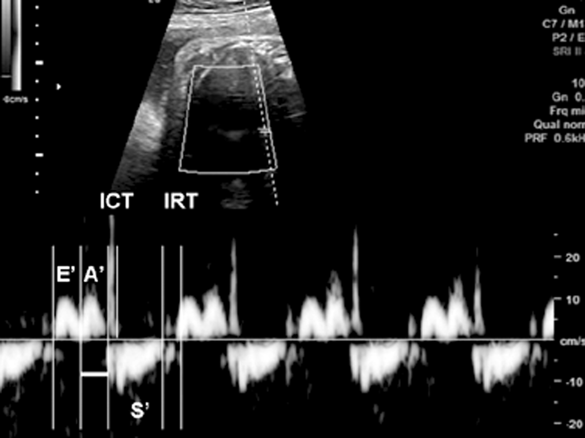 胎儿心电图心跳快是什么原因,胎儿心律不齐超声报告