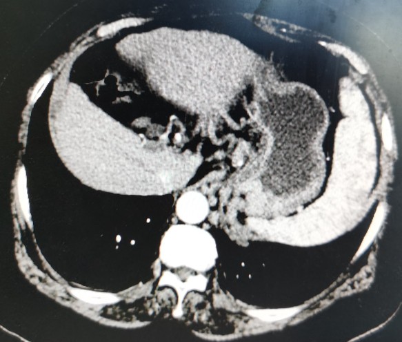 黄婶的肝癌用介入治疗已经3年多了-适合自己的治疗才是最好的治疗