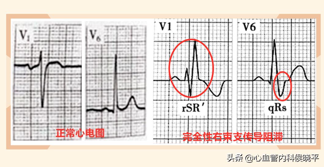 心脏右分支阻滞是怎么回事,心脏右束支传导不完全阻滞的危害