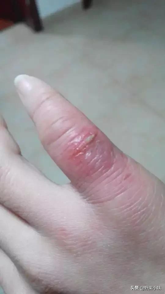 冻疮是怎么形成的原因是什么,冻疮严重溃烂的怎么治