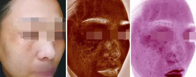 氨甲环酸对褐青斑有效果吗 (氨甲环酸去褐青斑吗)