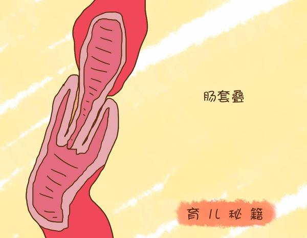 肠套叠和消化不良的区别,孩子肚子胀是着凉还是消化不好