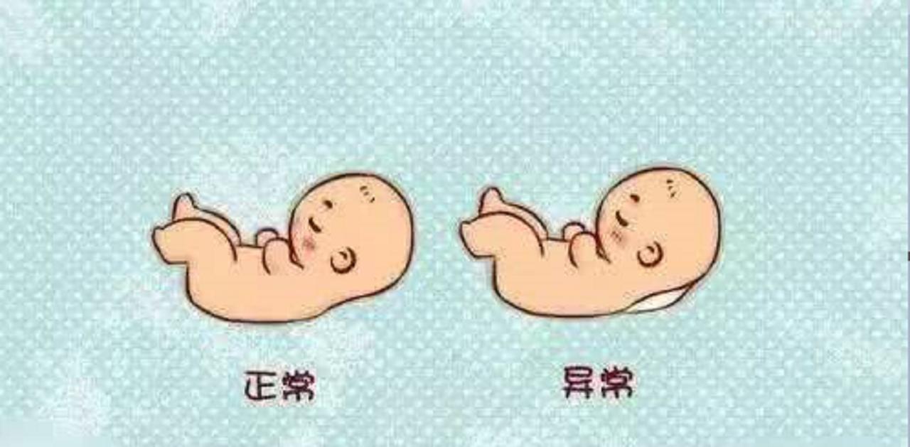 胎位不正错过四维时间还退钱吗,胎位不正应该早点剖吗