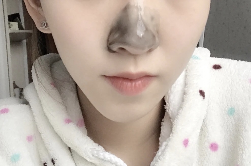 黑头怎么去除立竿见影,刮鼻子去黑头容易得酒糟鼻吗