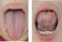 月经崩漏止血中药方,更年期月经崩漏止血的最快方法