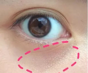 脸上莫名冒出白色小疙瘩,脸上出现奇怪的印子