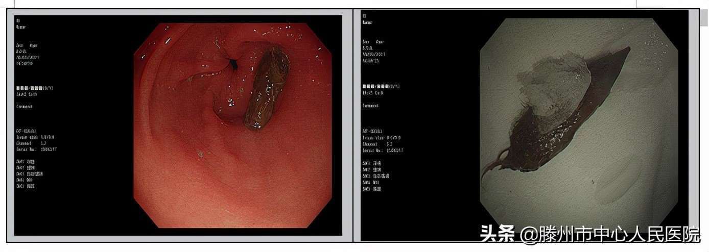 内镜下成功取出食管异物,消化内科取异物