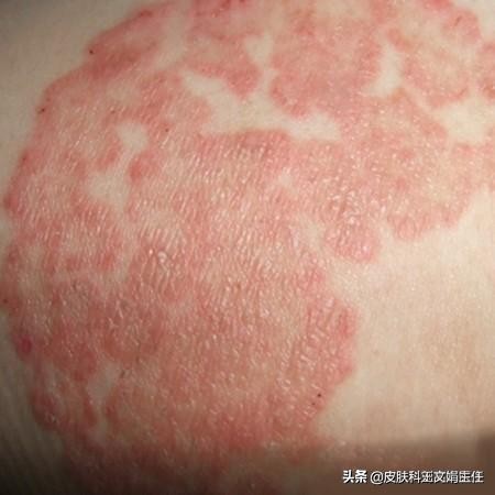 皮肤病的10种常用药治疗,18种常见皮肤病用药