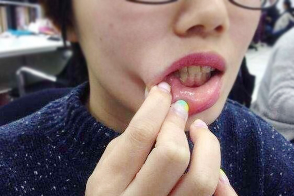 嘴起泡是排毒吗,嘴上起泡是身体在排毒吗