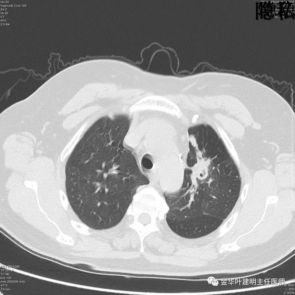 左肺下叶恶性病变,左肺上叶和下叶都有血管畸形