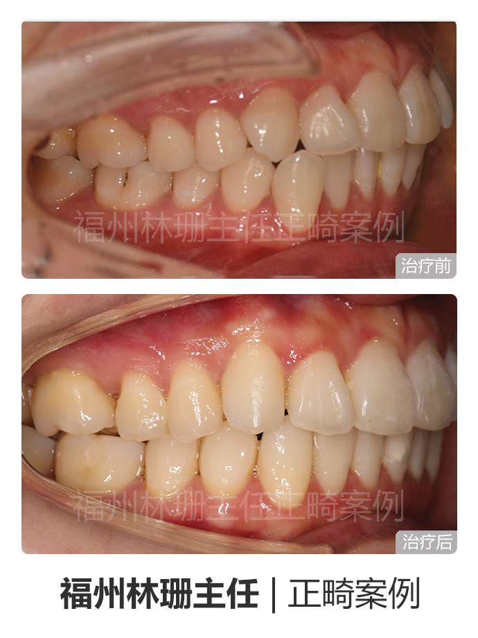福州晋安哪里矫正牙齿,福州牙齿畸形龅牙矫正