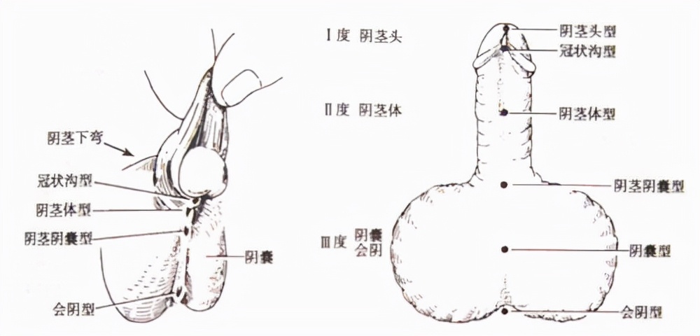 试管婴儿尿道下裂病因科普,尿道下裂伴随染色体异常如何处置