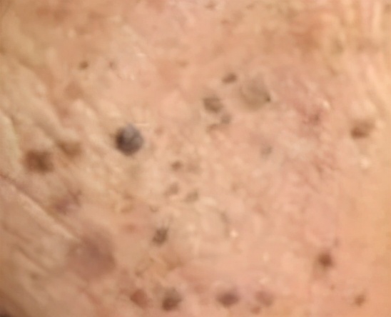 脸上长了闭口小颗粒怎么去除,脸上长白色小颗粒怎样去除掉