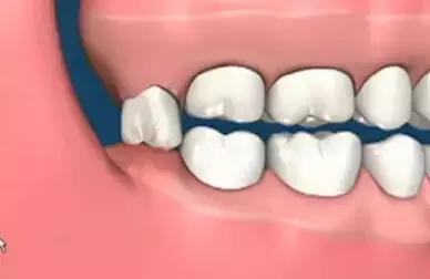 备孕前智齿一定要拔掉吗,正畸一定要拔掉智齿吗